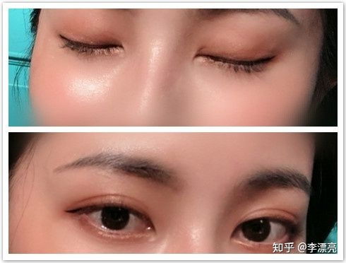 杭州哪里做双眼皮最好价位大概多少？