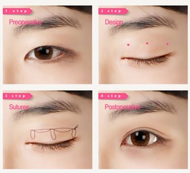 韩式三点双眼皮手术原理是什么？