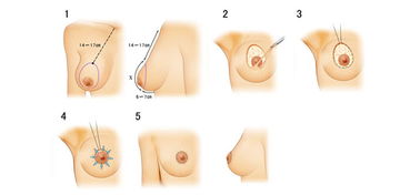乳房下垂悬吊术手术流程