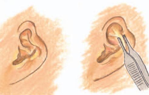 卷曲耳纠正手术是怎么样以伪乱真的流程详解
