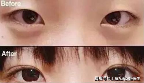 武汉五洲美莱的双眼皮割得怎么样？效果好吗？