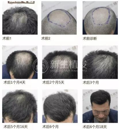 南京新生植发医院的TDDP技术到底怎么样啊？有网上说的效果那么好吗？
