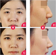 北京哪家医院鼻头整形做的效果最让人放心？