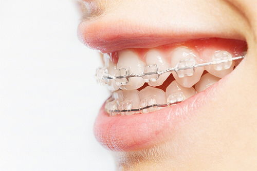 牙齿矫正需要多久？总共需要多少费用？