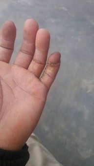 手指皮瓣手术已经三个月了。可以做手指整形吗》？
