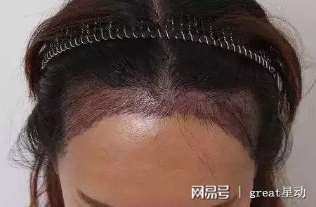 北京种植头发的新技术有哪些，效果怎么样？