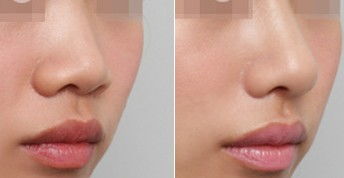 常见的隆鼻方法是哪些
