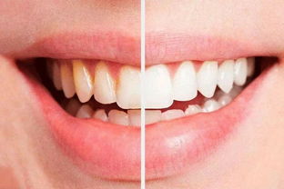 纳米蓝光美白牙齿优点有哪几种