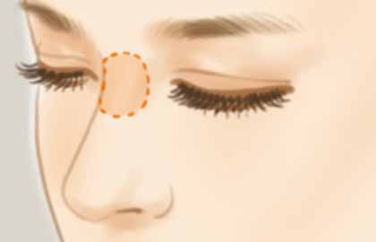 垫鼻梁从长期考虑有哪些副作用