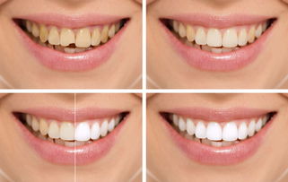 在牙齿矫正期间适合做牙齿美白吗？