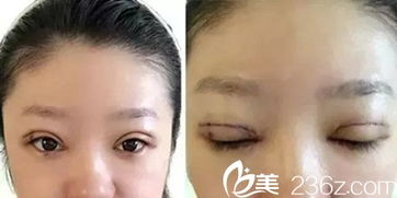 北京协和医院整形外科哪个医生做的双眼皮手术好？费用是多少？