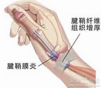 邯郸地区哪个医院能做小针刀腱鞘炎手术