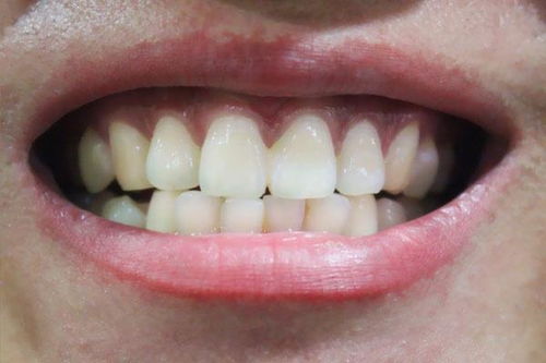 硅胶隆下巴手术完成之后不可刷牙齿怎么样清洁牙呢？