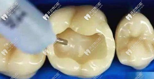 上次补牙一颗，医生说用的最好的意大利美塑树脂修复的，一颗牙收费一千多块钱，贵吗？