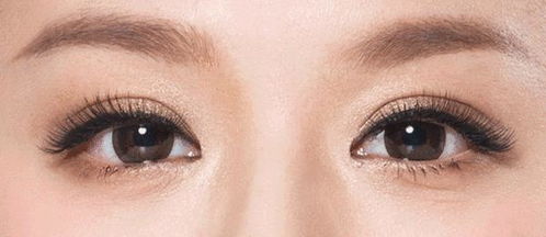 上眼皮提升可以改善眼睑下垂吗？