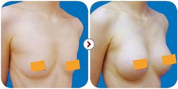 硅胶假体隆胸适合怎样的人？应该如何打理？