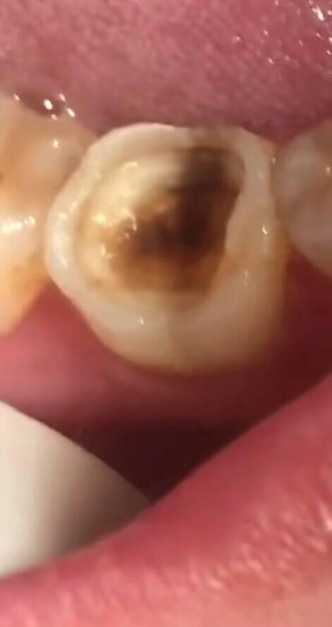 牙齿蛀了掉了半颗。属于口腔综合科还是口腔修复科？
