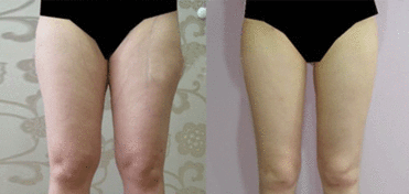 做大腿水动力吸脂手术效比360°环吸好吗