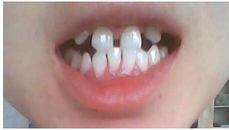 牙齿矫正需要多长时间？