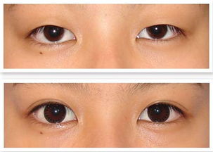 韩式双眼皮可用于哪些人群