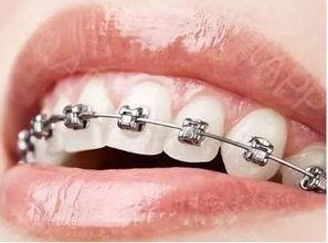 牙齿修复起码要多少钱？