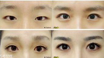 双眼皮和欧式双眼皮有什么区别呢？