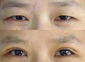 洛阳哪里做韩式双眼皮手术好？