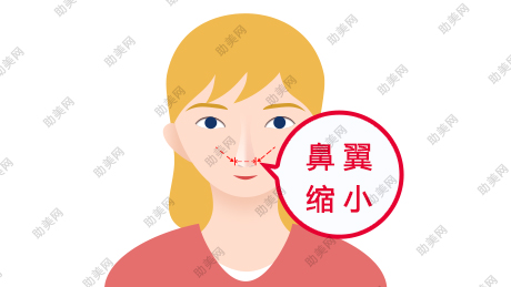 <a href='/tag_biyizhengxingshou2.html'>鼻翼整形手术</a>方法有哪些呢