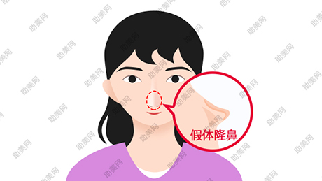 韩式隐形立体隆鼻有何优势