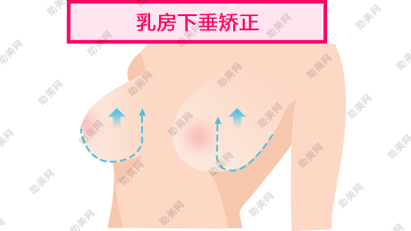 乳房下垂的类型可分哪几类